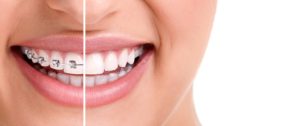 Dental Orthodontics Services Singapore