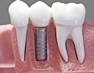 tooth implant Singapore