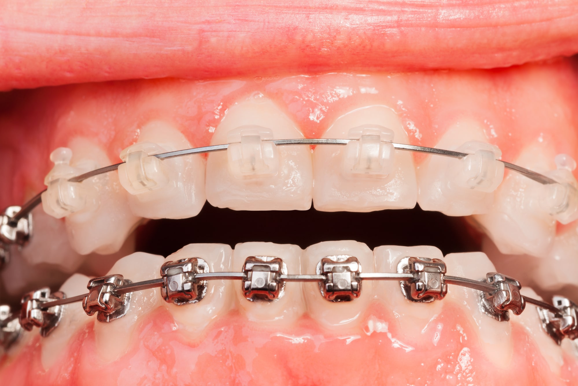 Ceramic Braces Singapore Dental Orthodontics 