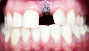All-on-4 dental Implants Singapore