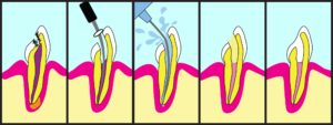 Root Canal Treatment Singapore