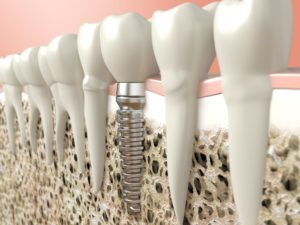Dental Implant Singapore