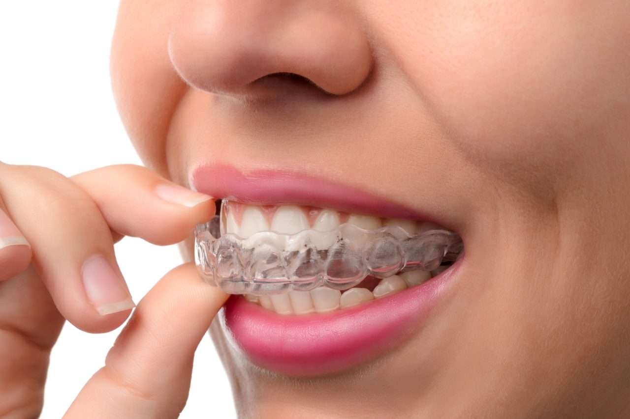 Invisalign Braces Singapore CustomMade Clear Removable Aligners